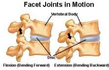 Disc bulging Disc narrowing Facet joint changes - thickening of ligamentum flavum sclerosis of bone on the facet joints.
