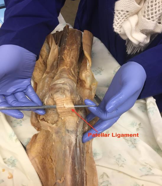 EXTRA-ARTICULAR Patellar Ligament The first and most anterior extracapsular ligament that helps provide stability to the tibiofemoral joint is the patellar ligament.