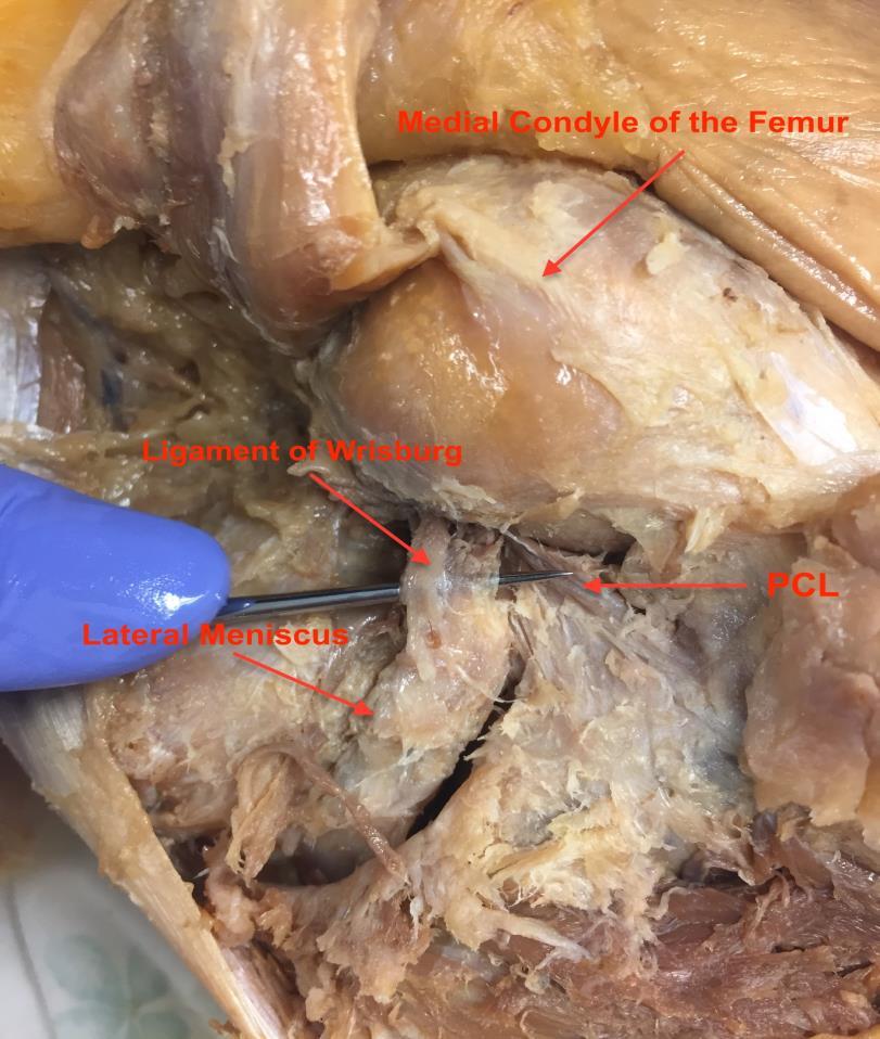 BONES Figure 7. Cadaveric Dissection of the Ligament of Wrisberg The tibiofemoral joint is the largest and most superficial joint in the body.