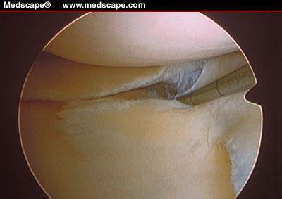 These tears divide the meniscus into superior and inferior flaps. They have little or no healing capacity.