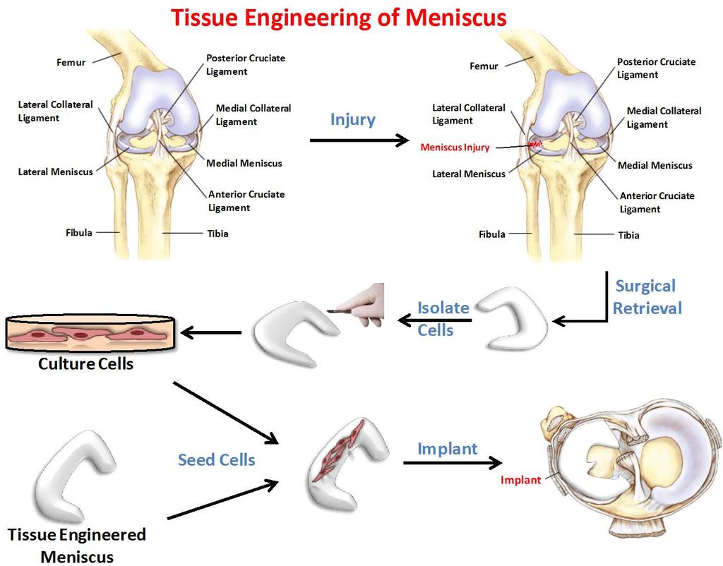 Figure 13. A working model for total meniscus replacement using an autologous seeding procedure.