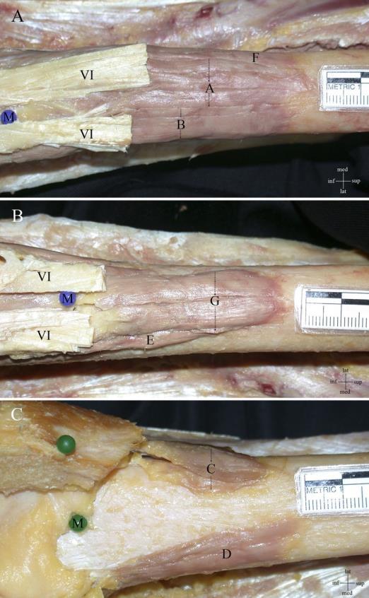 Figure 2. Cadaveric Dissection of the Articularis Genu.