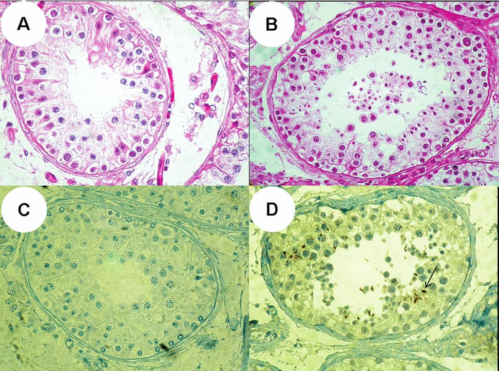 FIGURE 1 Histologic examinations of testicular biopsy samples from men with nonobstructive azoospermia.