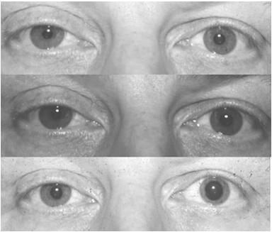 lesions do not cause anisocoria Adie s Tonic Pupil IIIrd nerve