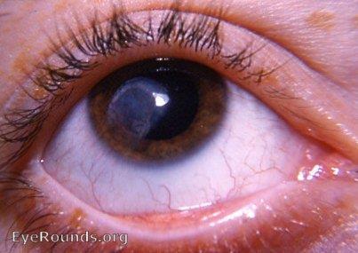 Herpes simplex keratitis Clinical presentation Photophobia May not have as many complaints as exam