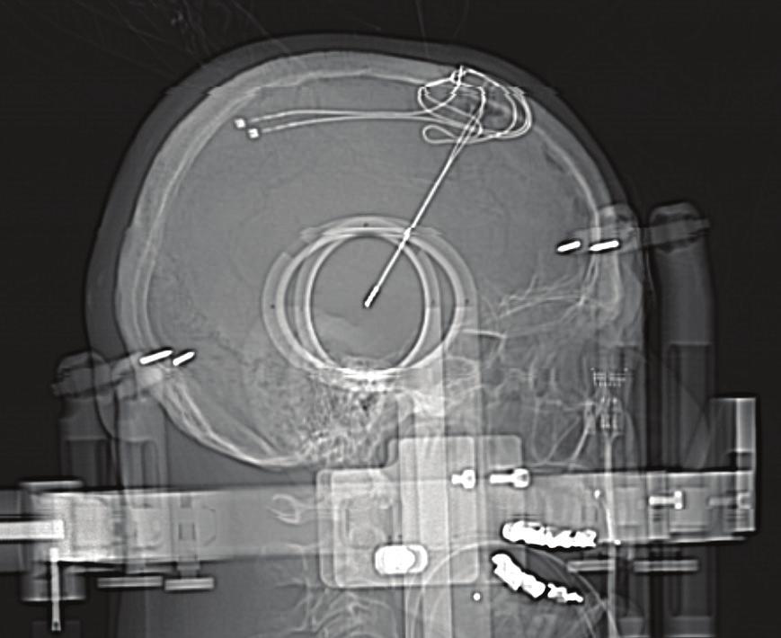 NeuroLogica BodyTom Case Studies I Page 2 Cranial case study Framed stereotactic bilateral deep