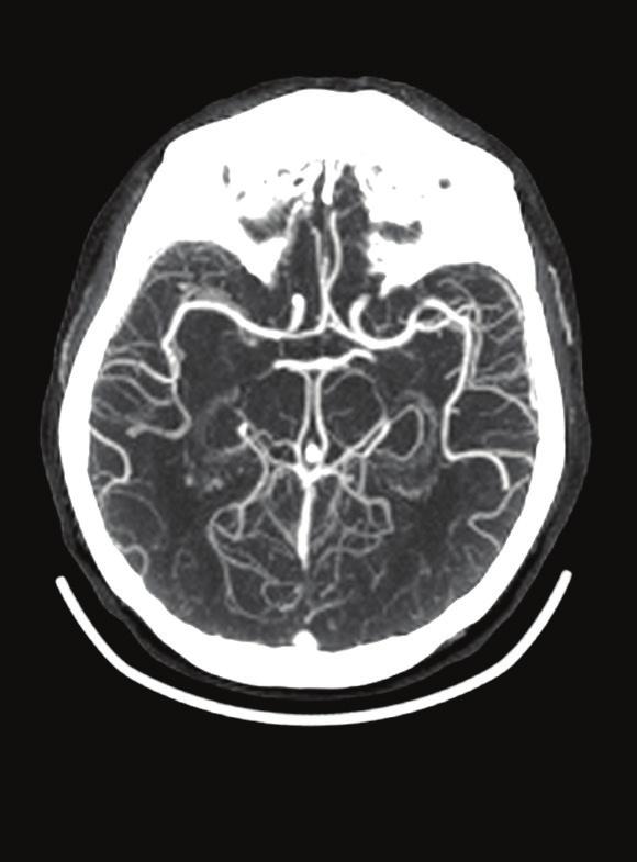 Cranial case study Intraoperative CT angiography Intraoperative CT angiography for PCOM