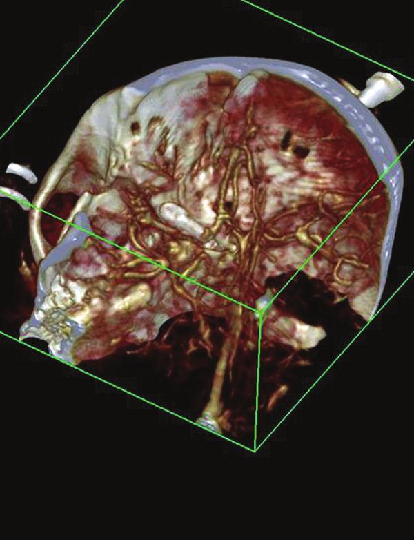 unruptured posterior communicating artery (PCOM) aneurysm that required surgical intervention
