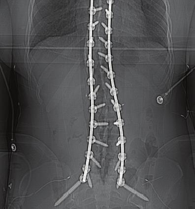 NeuroLogica BodyTom Case Studies I Page 4 Spinal case study Navigated spinal fusion
