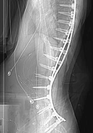 Neuromuscular Scoliosis Patient was wheelchair bound before the surgery Pre-op