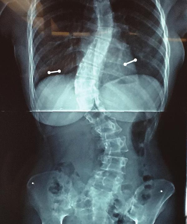 obtained intraoperatively followed by a full spine CT scan which was transferred