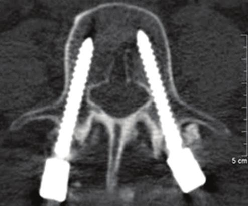 Spinal case study Intra-op CT confirms the correct pedicle screw placement