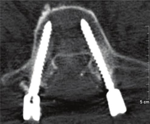 male presenting lumbar disc degeneration with loss of height and instability