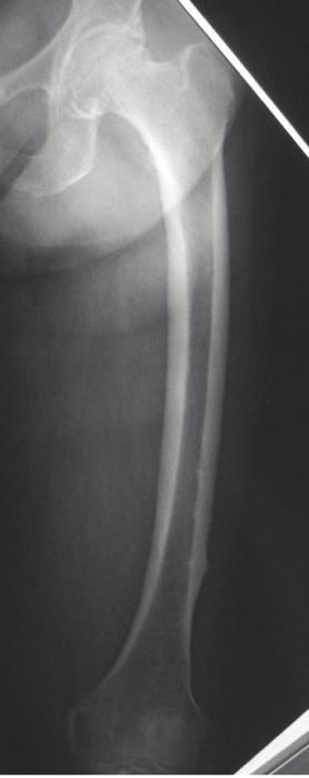 2 Case Reports in Orthopedics Figure 1: Anteroposterior radiographs of the left femur. is a magnified view of.