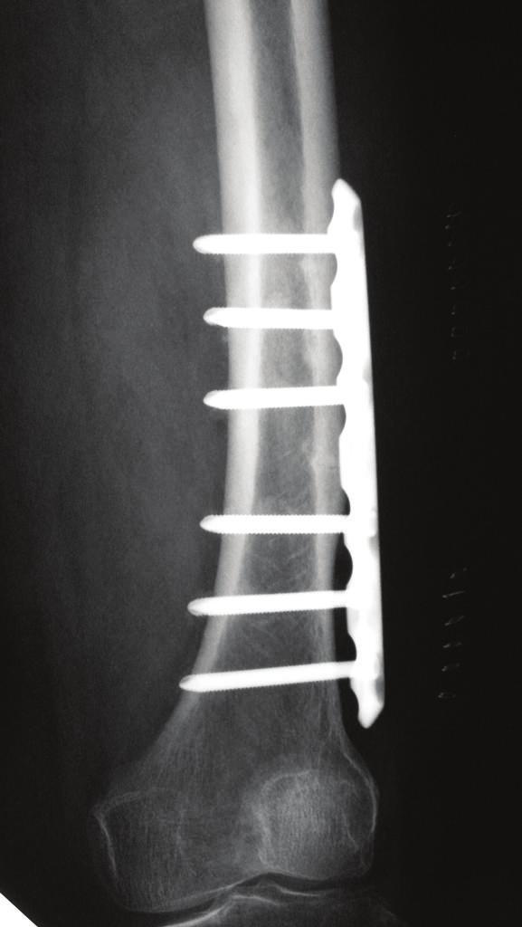 The patient was treated surgically using locking plates to prevent complete fracture of the femur (Figure 2).
