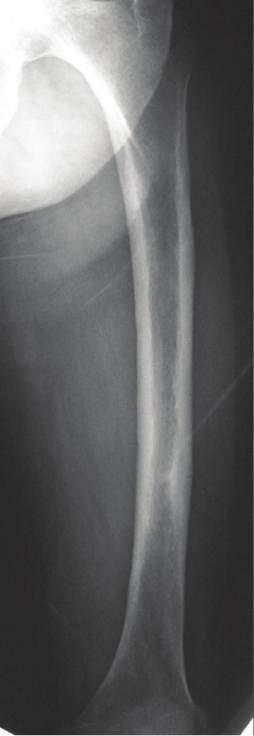 Although it has been reported that AFF is affected by many factors, The ASBMR Task Force stated that a curved femur is often seen in Asian patients [3].