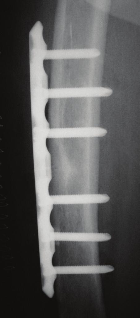 4 Case Reports in Orthopedics Figure 5: Anteroposterior radiographs of the bilateral femurs treated surgically using locking plates. Black arrows show original horizontal line.