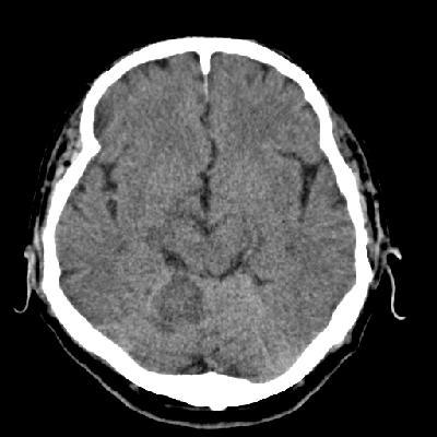 Case 3 24 hour repeat CT Case 3 48 hour repeat CT Case 3 Posterior circulation stroke Can result in severe