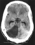 of the brainstem With signs of brainstem compression, mortality about 80% without surgery Surgery reduces