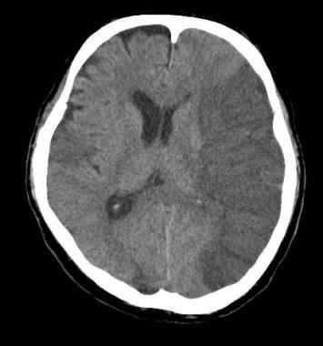 Case 7 78 year old female with R MCA stroke 3 days ago More difficult to arouse since having a seizure 2 hours ago Seizure treated with Lorazepam Thought to be sleepy secondary to this With