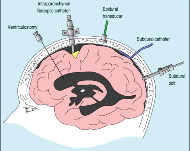 Advanced Monitoring Multimodal Monitoring in the ICU Intracranial pressure (ICP) Brain temperature Brain tissue oxygenation Jugular