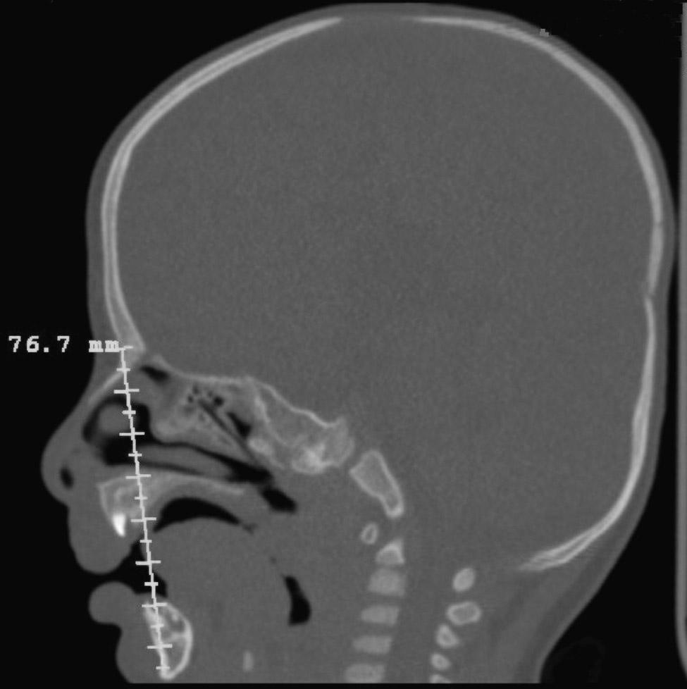 ACCURACY OF CRANIOFACIAL MEASUREMENTS / Frühwald et al Pfeiffer syndrome, and one from microcephalus.
