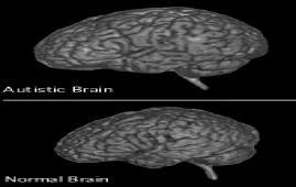 Introduction to Autism Brain Size Enlarged Brain weight & Head Circumference Normal brain size at