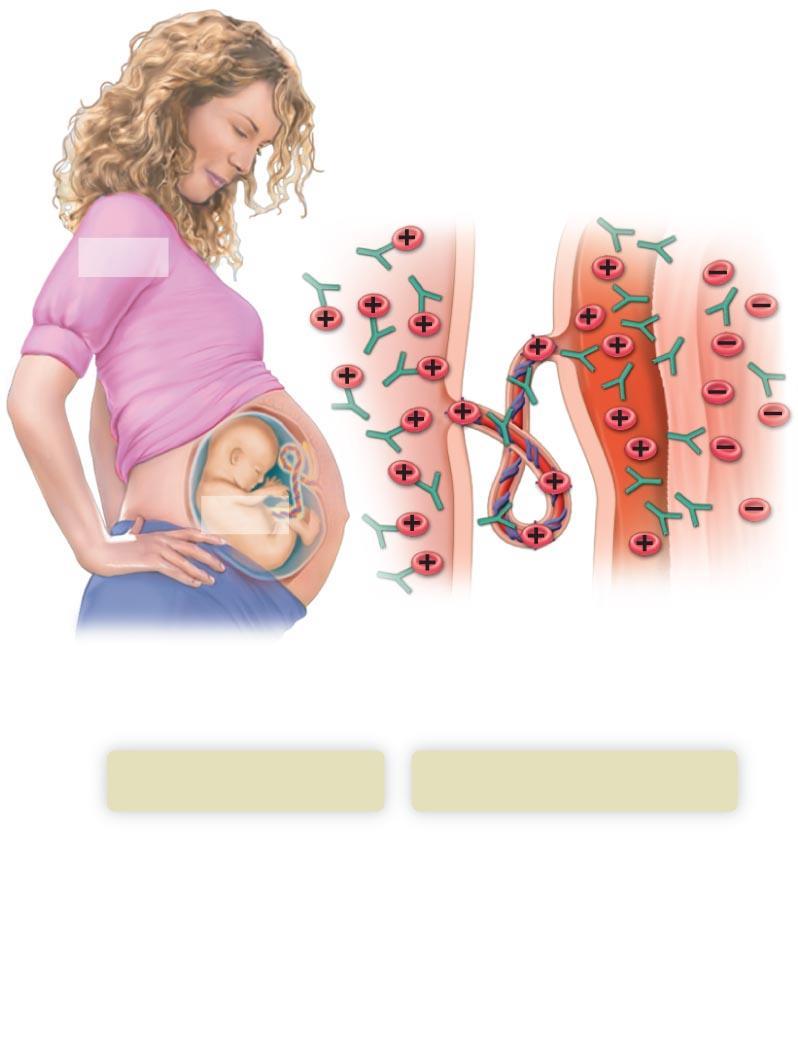 Anti-Rh antibodies Anti-Rh antibodies RH RH + Fetal circulation Maternal circulation d) When the woman becomes pregnant with