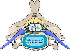 Spinal Muscular Atrophy Progressive autosomal recessive