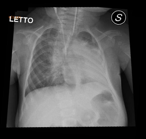 CASE 2: ARIANNA, 12 months old, F, SMA1 after 20 days Respiratory exacerbation Emergency Department In the last two days : fever Increased secretions recurrent Hypoxemia below 80% SaO2, despite