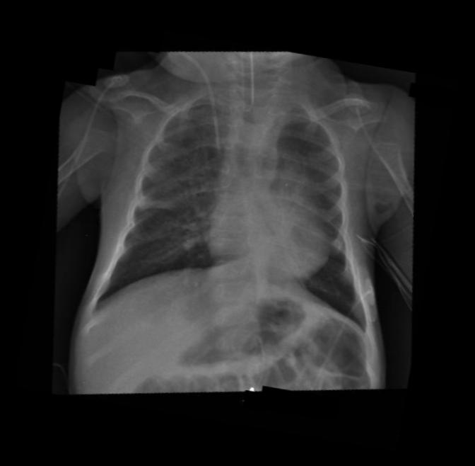 CASE 2: ARIANNA, 12 months old, F, SMA1 Pediatric Intensive Care Unit Mechanical Invasive Ventilation (SIMV/PSV FiO2 0,35) Airway clearance Antibiotic iv therapy Progressive clinical and chest X ray