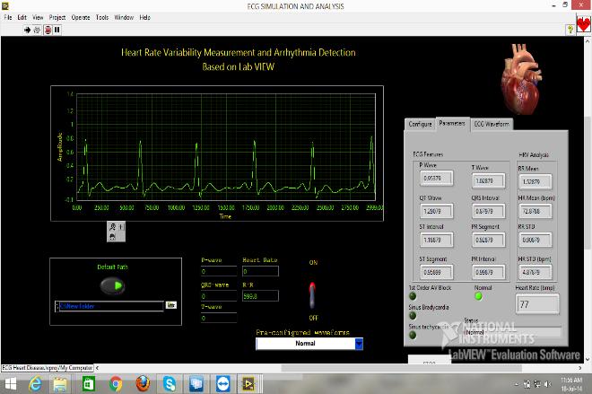 output device (laptop). Signal Processing in LabVIEW- Includes the signal processing tools such as LPF, HPF and BPF in order to remove the base line wandering and noise from acquired raw ECG signal.