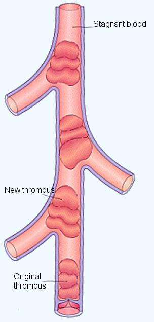Propagation progressive spread of thrombosis distally in