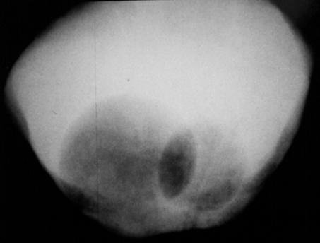 Figure 10. Cystogram showing a right-sided, smooth-walled filling defect consistent with a ureterocele next to the filling defect from a catheter balloon. of the VCUG.
