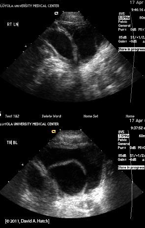 Unknown Bladder Object Density: (remember, this is an ultrasound) Hypoechoic (fluid urine) Summary: Cystic, fluid