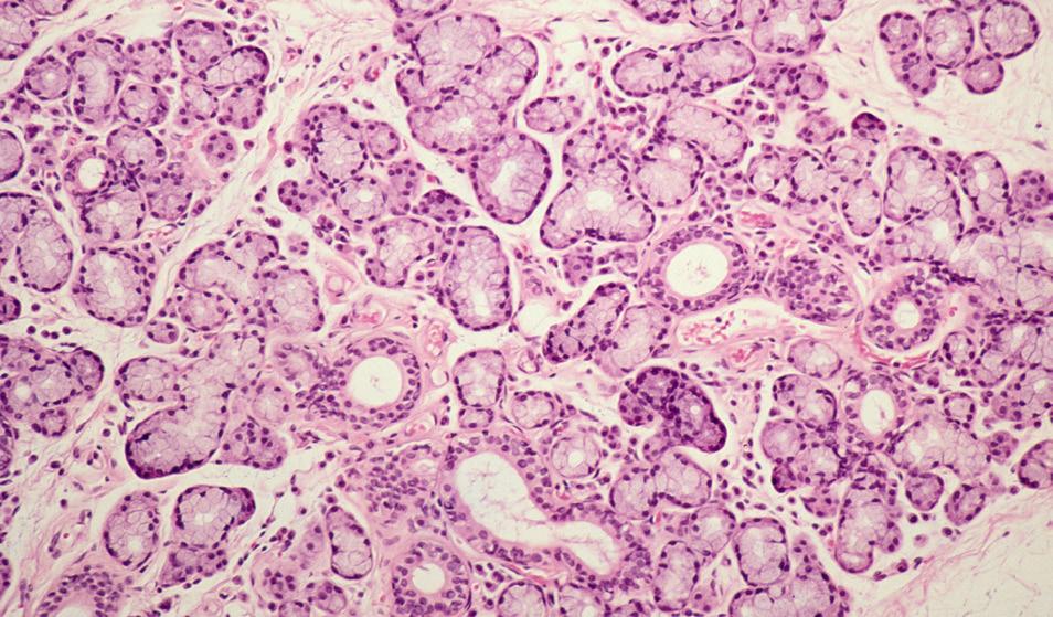 CHAPTER 15 CLINICAL INVESTIGATIONS JOOP P VAN DE MERWE - SJÖGREN S SYNDROME: INFORMATION FOR PATIENTS AND PROFESSIONALS Lip biopsy - sensitivity for Sjögren s syndrome: 60-82% 4 - specificity: 85% 2