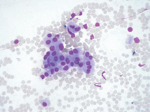 Fig.2: Oncocytoma. The neoplastic oncocytic epithelium is arranged in clusters. The cells are round to oval monomorphic nuclei with abundant densely granular cytoplasm.