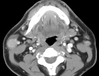Warthin s Cystadenoma lymphomatosum Only parotid Elderly men and women (smoking, prior radiation)