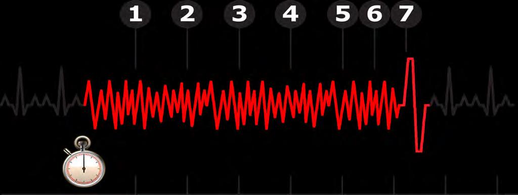 WCA Sequence of Events in Activation 1. Arrhythmia detected, activating vibration alert (continues throughout sequence). 2.