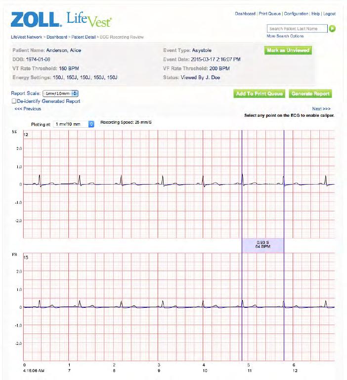 Patient Data Management Features ECG Review ECG information captured by the LifeVest can be used