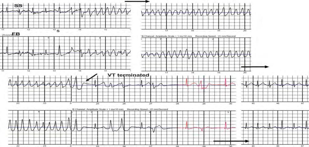 WCD ECG of a Self-Terminating rapid VT (torsade de pointes-type) event LifeVest electrocardiogram recording of a self-terminating rapid ventricular tachycardia (torsade de pointes-type) event,