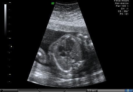 no other fetal malformations GA at diagnosis: 22 weeks Diagnosis: large