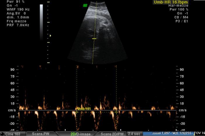 maternal electrocardiographic alterations) No more organized fetal