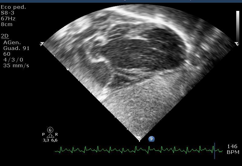 At birth: confirmation of thinning and dyskinesia of the muscular free left ventricular wall