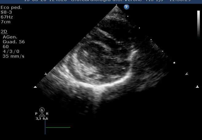 Six months later: worsening of left ventricular systolic function, with a decreased ejection