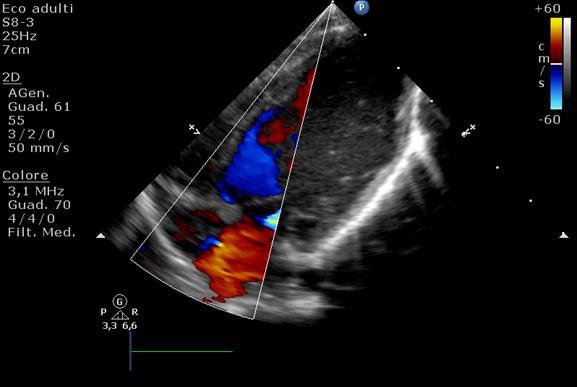 episode of atrial flutter with atrioventricualr conduction 2:1, spontaneous return to sinus