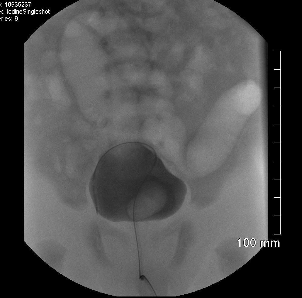 Case 3 Left Ectopic Ureterocele 2 weeks- VCUG Ureterocele left of midline.