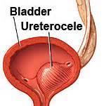 Ureterocele Congenital dilatation of intramucosal segment of ureter with prolapse into bladder Incidental finding in work-up of hydronephrosis Often associated with duplicated collecting system