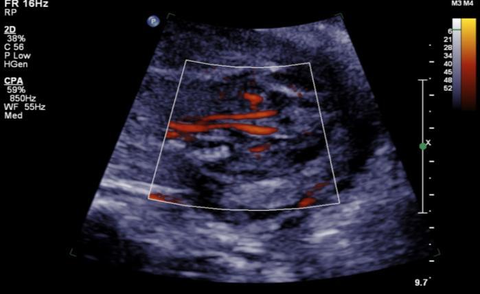 Case 4 Bilateral Renal Agenesis Pregnancy course: Genetic counseling No