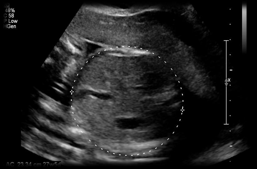 Female fetus.